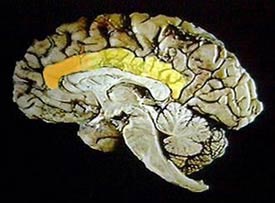 Le cortex cingulaire (en jaune) et sa partie antrieure (en orange) sur une coupe sagittale du cerveau